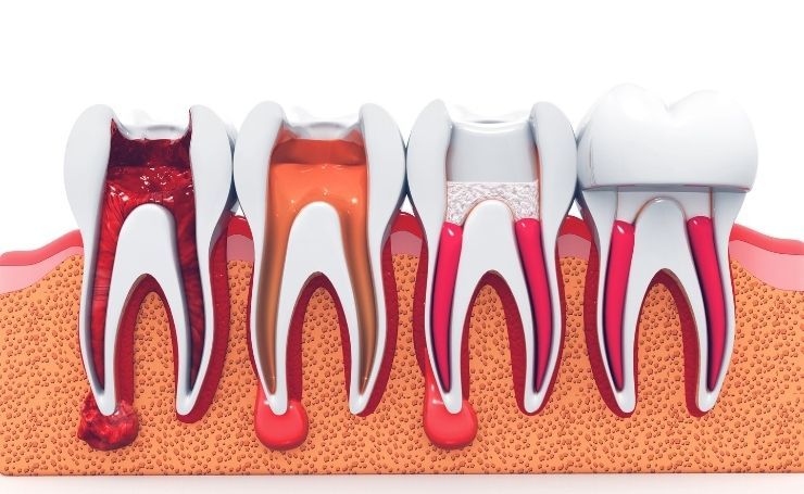 endodoncia