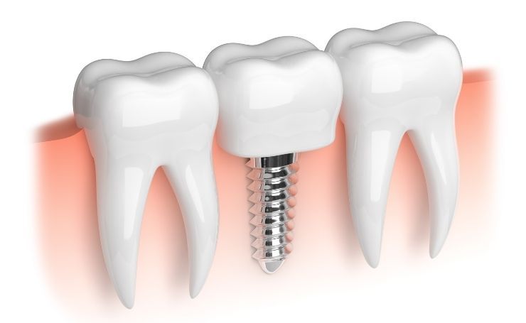 implantes dentales en CDMX