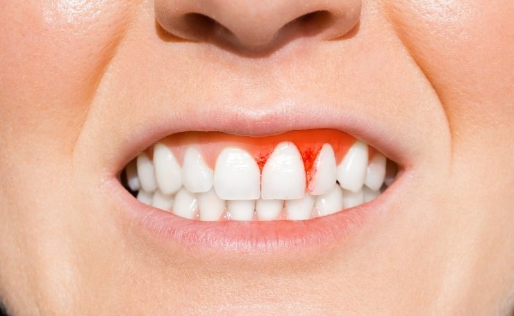 periodoncia en CDMX
