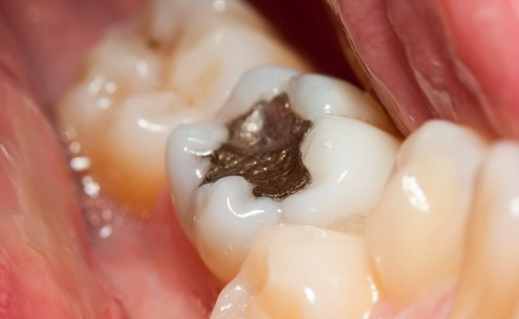 resinas dentales en CDMX