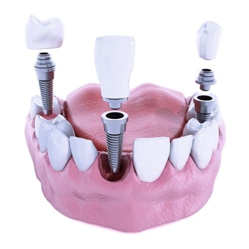 implante dental
