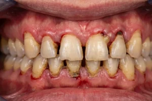 periodontitis enfermedad bucal