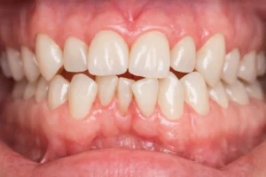 apiñamiento dental